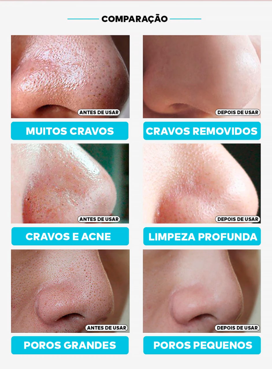 Removedor de cravos, creme de controle de oleosidade, creme removedor de cravos e poros, lanbena, creme lanbena, skincare, creme para espinhas e cravos, creme de limpeza facial